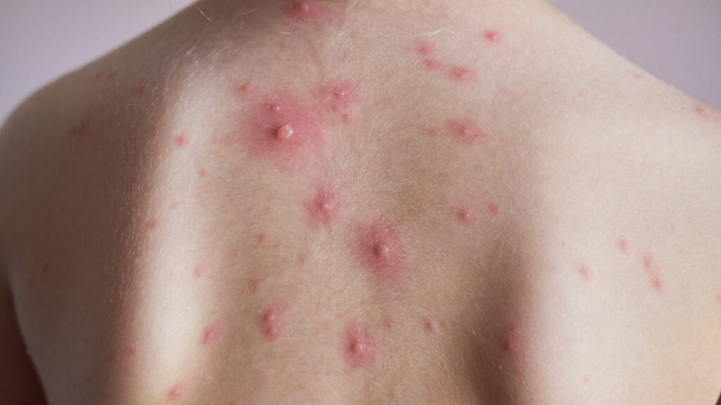 Medidas Preventivas y de Control ante brote de Varicela destacada 2