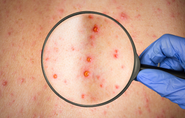 Medidas Preventivas y de Control ante brote de Varicela